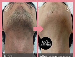 男性の脱毛について女性の方に聞いてみました！のイメージ