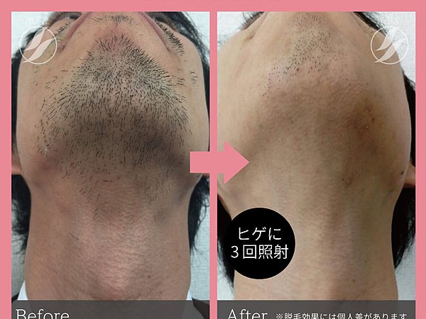 男性の脱毛について女性の方に聞いてみました！の画像